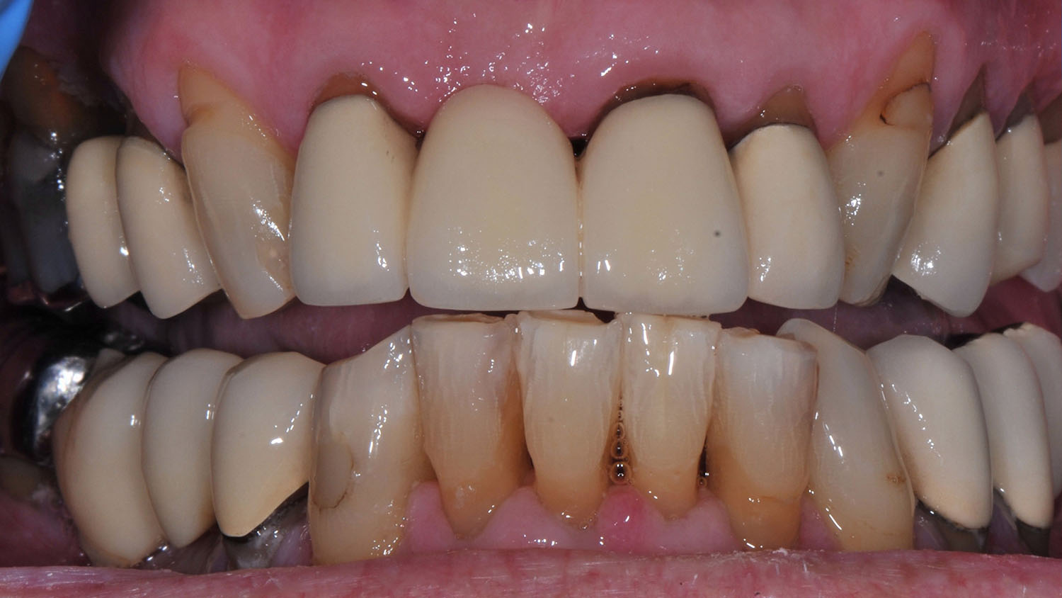 Exposed Nerves? How an Emergency Dentist Can Help